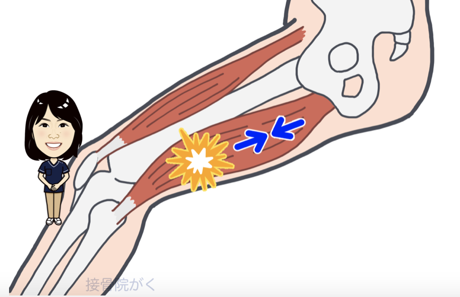 肉離れの原因と改善方法 伊勢崎市で夜21時迄受付の接骨院